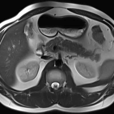MRI-scan van de buik