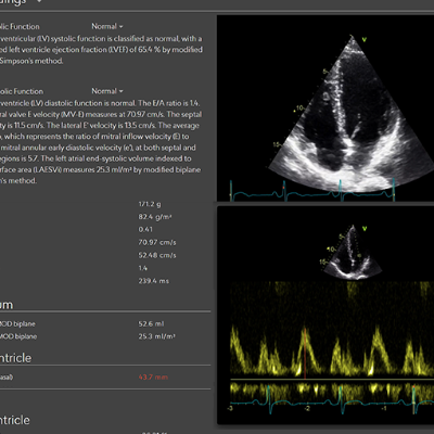 US2.ai software voor AI-ondersteunde analyse van echobeelden van het hart