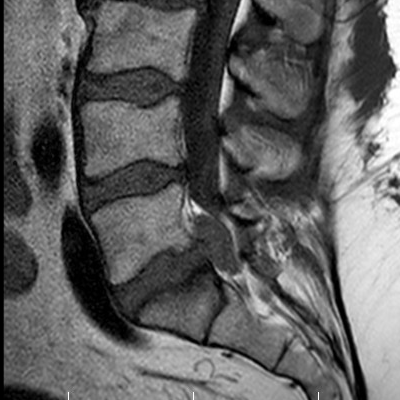 MRI onderrug onderzoek bij ScanClinic