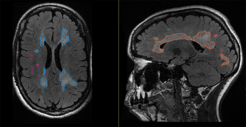 ScanClinic BrainAge – hersenanalyse visual